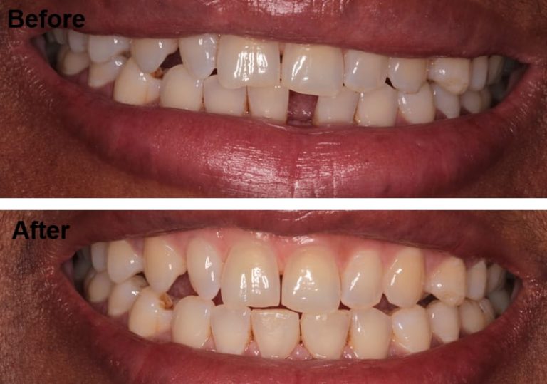 lds-invisalign-and-bonding-before-and-after.jpg