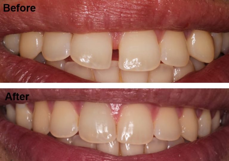 lds-invisalign-befoare-and-after.jpg