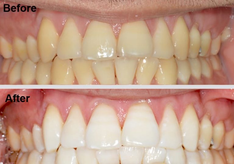 london-dental-studio-teeth-whitening-1.jpg